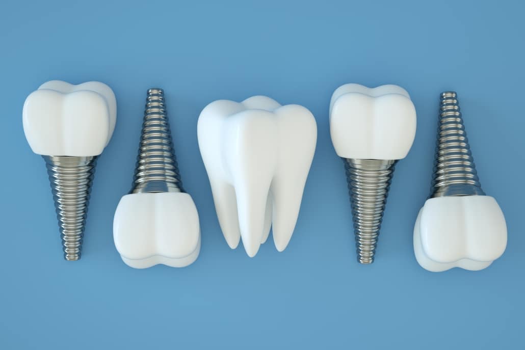 Permanent Teeth in a Day: All-on-X Dental Implants in Mundelein with Dr. Ryan Bogard