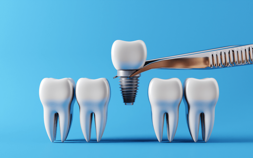 The Benefits of Dental Onlays for Athletes