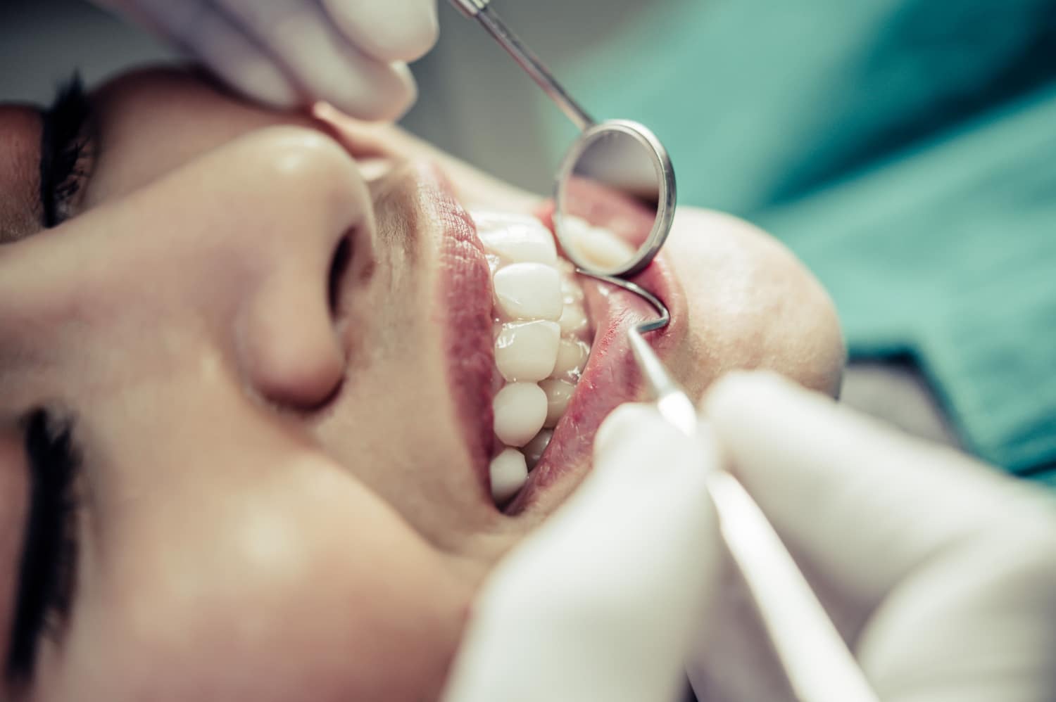 What Are the Advantages of Getting Onlays for Your Teeth?