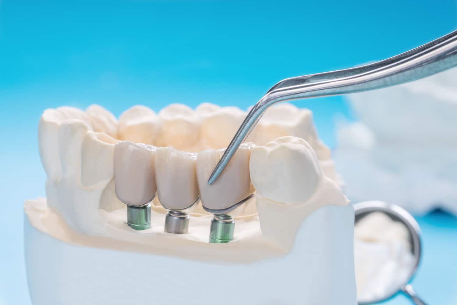 What Should I Do to Take Care of My Dental Crowns?