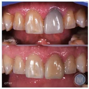Before and after dental treatment at Markiewicz Dental, Mundelein