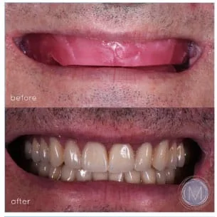Before and after dental treatment at Markiewicz Dental, Mundelein