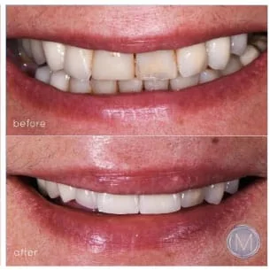 Before and after dental treatment at Markiewicz Dental, Mundelein