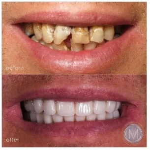 Before and after dental treatment at Markiewicz Dental, Mundelein