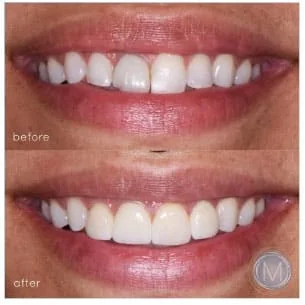 Before and after dental treatment at Markiewicz Dental, Mundelein