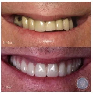 Before and after dental treatment at Markiewicz Dental, Mundelein