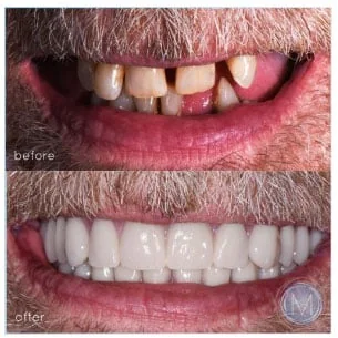 Before and after dental treatment at Markiewicz Dental, Mundelein