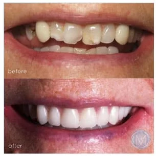Before and after dental treatment at Markiewicz Dental, Mundelein