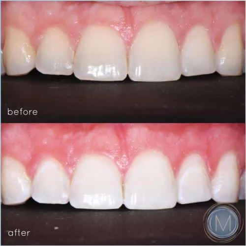 Before and after dental treatment at Markiewicz Dental, Mundelein