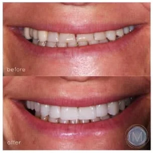 Before and after dental treatment at Markiewicz Dental, Mundelein