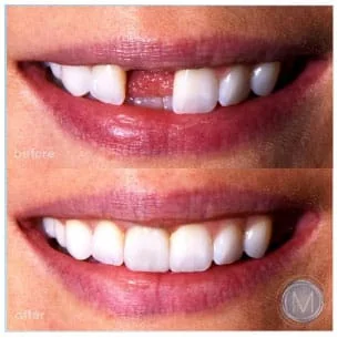 Before and after dental treatment at Markiewicz Dental, Mundelein