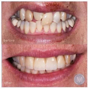 Before and after dental treatment at Markiewicz Dental, Mundelein