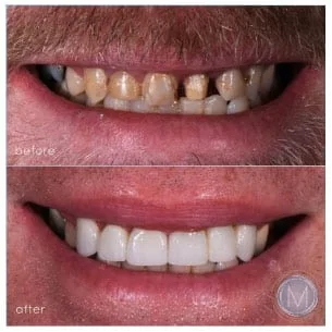Before and after dental treatment at Markiewicz Dental, Mundelein