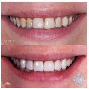 Before and after dental treatment at Markiewicz Dental, Mundelein