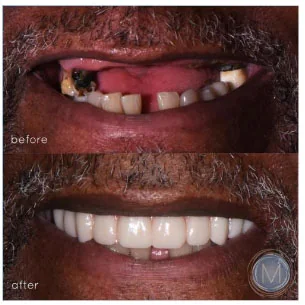 Before and after dental treatment at Markiewicz Dental, Mundelein