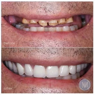 Before and after dental treatment at Markiewicz Dental, Mundelein