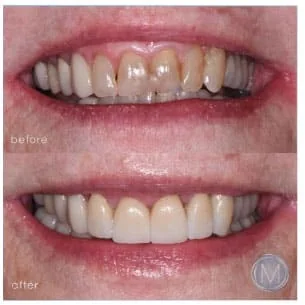 Before and after dental treatment at Markiewicz Dental, Mundelein