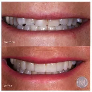 Before and after dental treatment at Markiewicz Dental, Mundelein