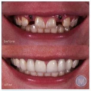 Before and after dental treatment at Markiewicz Dental, Mundelein