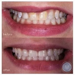 Before and after dental treatment at Markiewicz Dental, Mundelein