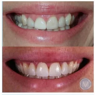 Before and after dental treatment at Markiewicz Dental, Mundelein