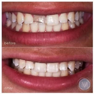 Before and after dental treatment at Markiewicz Dental, Mundelein