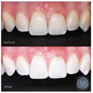 Before and after dental treatment at Markiewicz Dental, Mundelein
