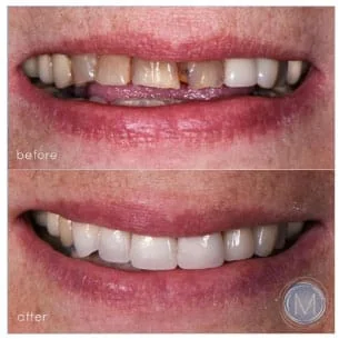 Before and after dental treatment at Markiewicz Dental, Mundelein