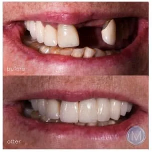 Before and after dental treatment at Markiewicz Dental, Mundelein