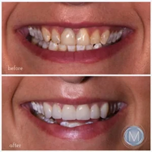Before and after dental treatment at Markiewicz Dental, Mundelein