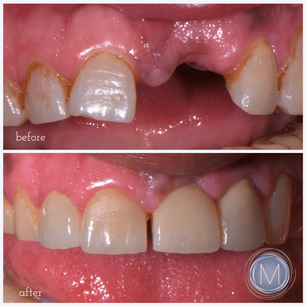 Before and after dental treatment at Markiewicz Dental, Mundelein