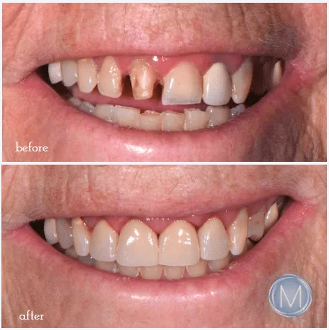 Before and after dental treatment at Markiewicz Dental, Mundelein