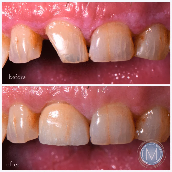 Before and after dental treatment at Markiewicz Dental, Mundelein