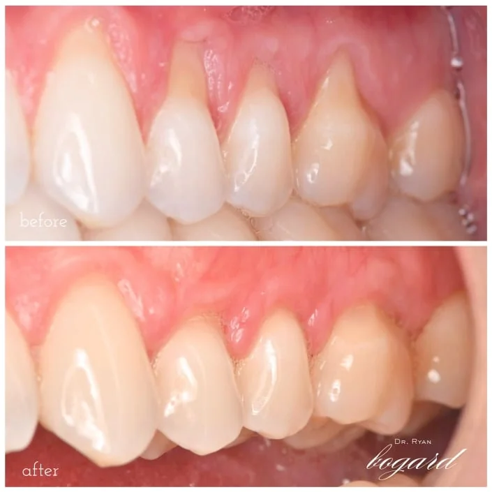 Before and after dental treatment at Markiewicz Dental, Mundelein