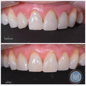 Before and after dental treatment at Markiewicz Dental, Mundelein