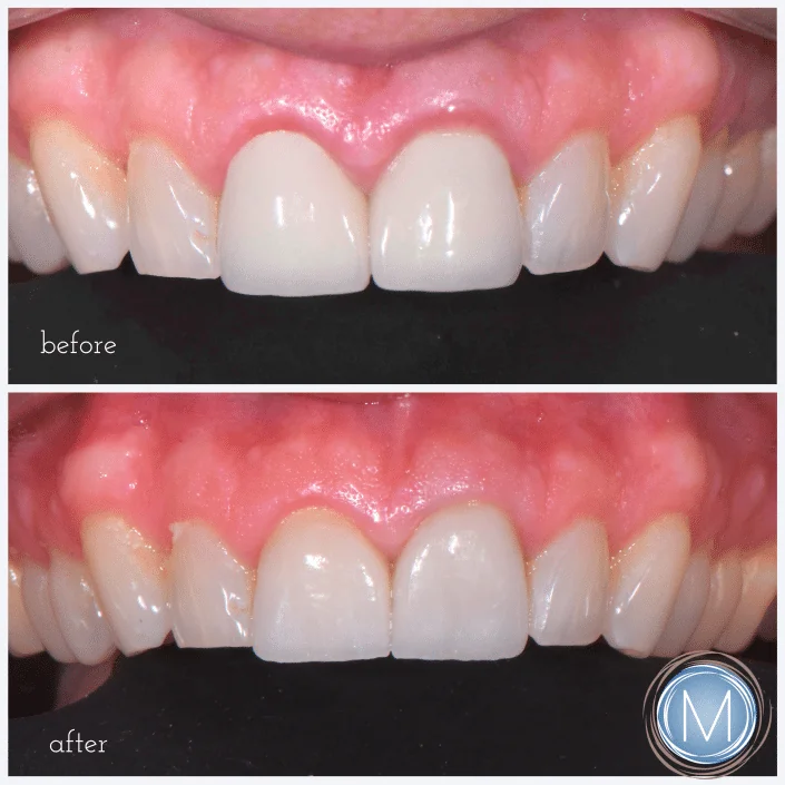 Before and after dental treatment at Markiewicz Dental, Mundelein