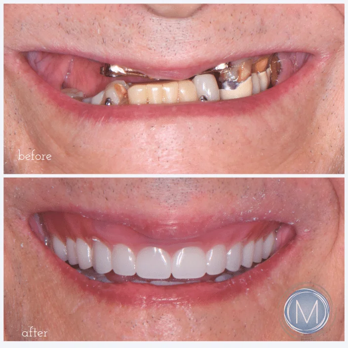 Before and after dental treatment at Markiewicz Dental, Mundelein