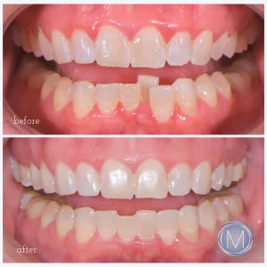 Before and after dental treatment at Markiewicz Dental, Mundelein
