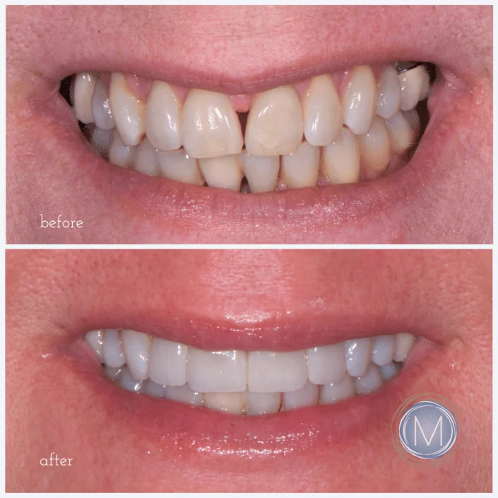 Before and after dental treatment at Markiewicz Dental, Mundelein