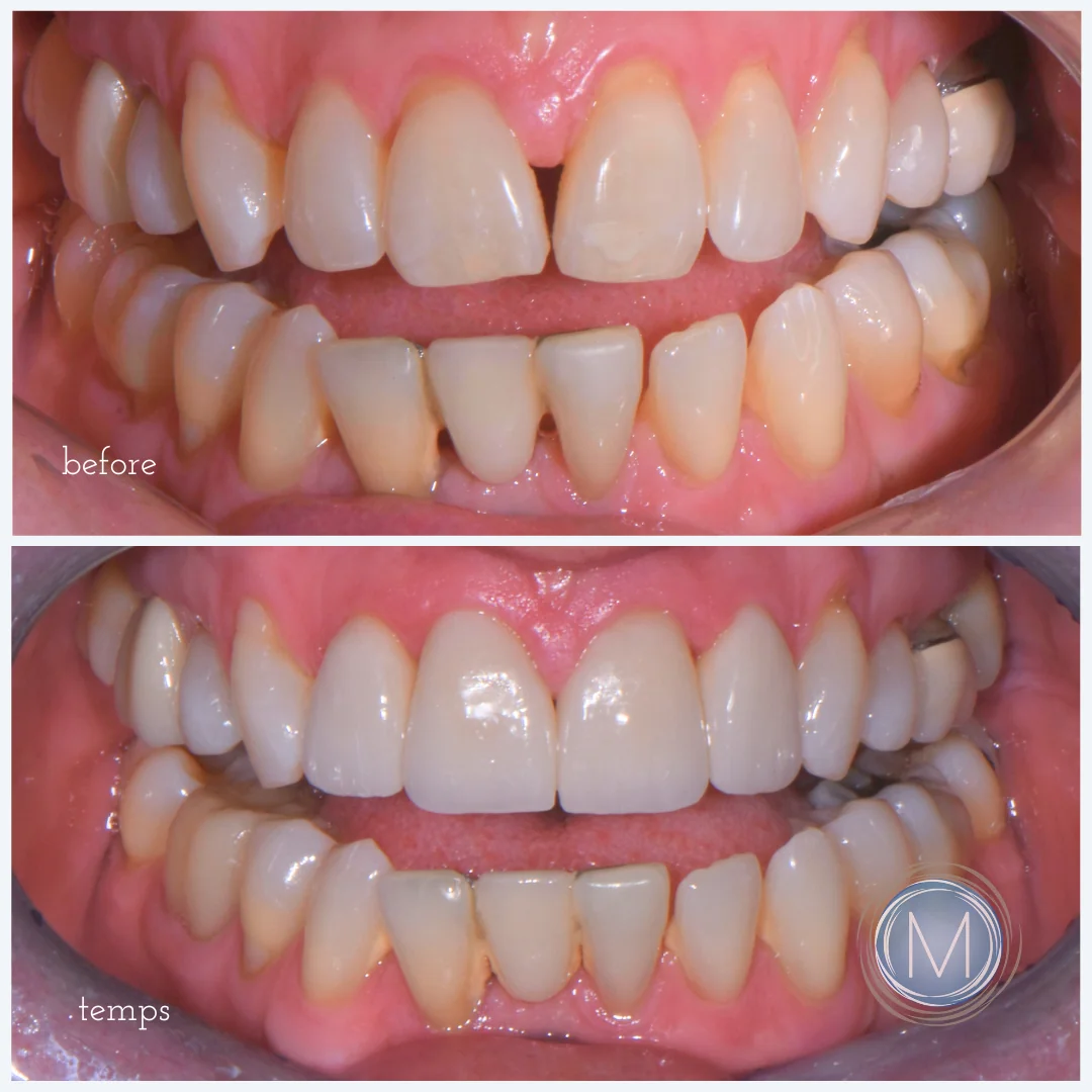 Before and after dental treatment at Markiewicz Dental, Mundelein
