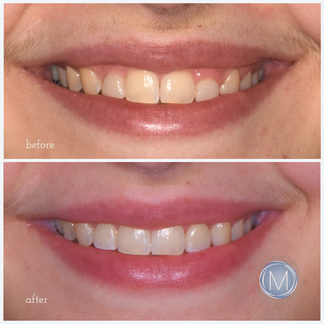 Before and after dental treatment at Markiewicz Dental, Mundelein