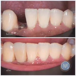 Before and after dental treatment at Markiewicz Dental, Mundelein