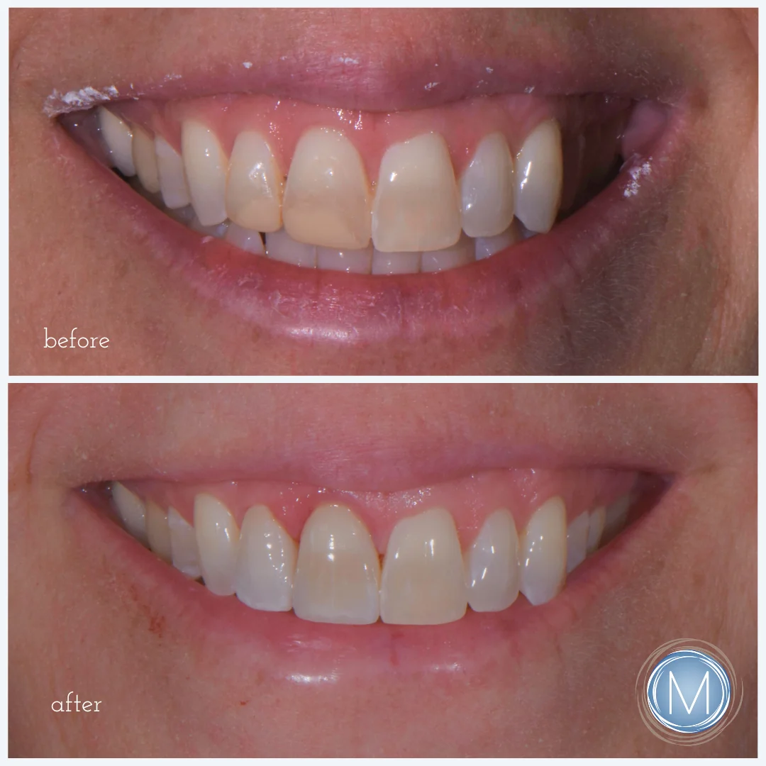 Before and after dental treatment at Markiewicz Dental, Mundelein