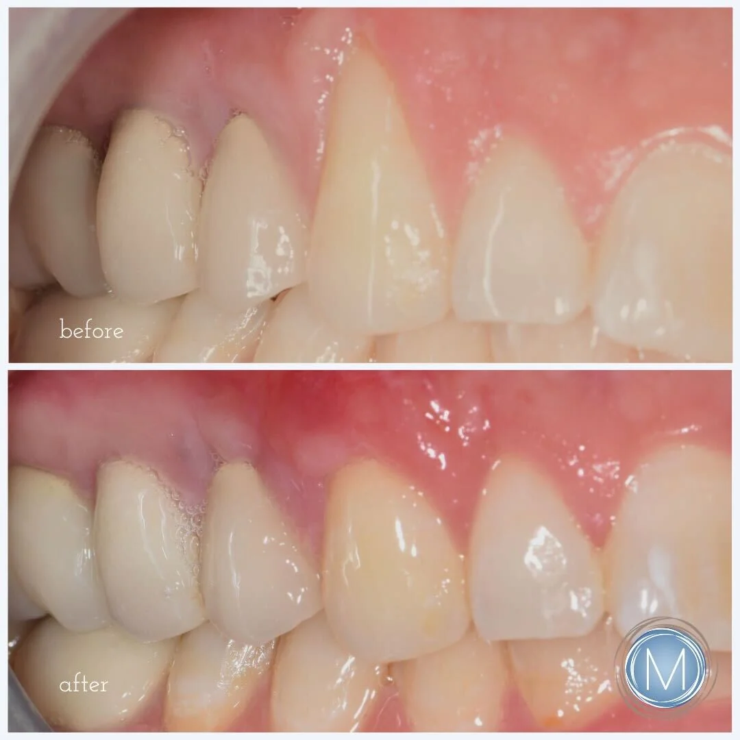 Before and after dental treatment at Markiewicz Dental, Mundelein