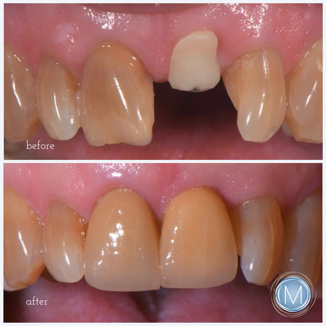 Before and after dental treatment at Markiewicz Dental, Mundelein