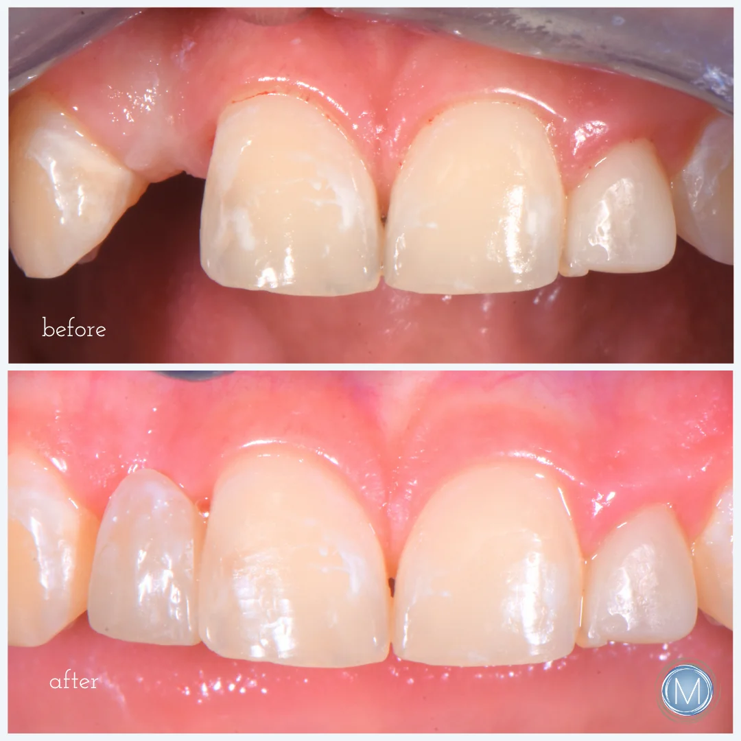Before and after dental treatment at Markiewicz Dental, Mundelein