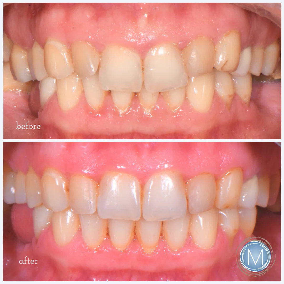 Before and after dental treatment at Markiewicz Dental, Mundelein