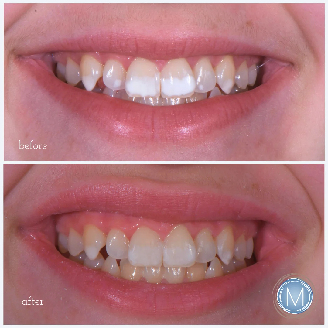 Before and after dental treatment at Markiewicz Dental, Mundelein
