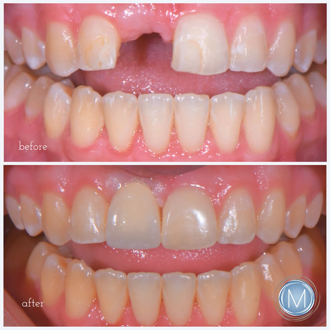 Before and after dental treatment at Markiewicz Dental, Mundelein