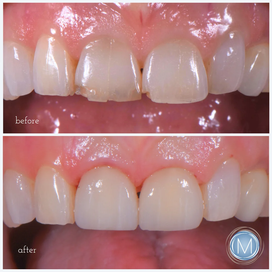 Before and after dental treatment at Markiewicz Dental, Mundelein
